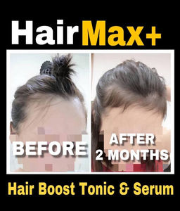 Female Late 20s Postpartum Hair Loss