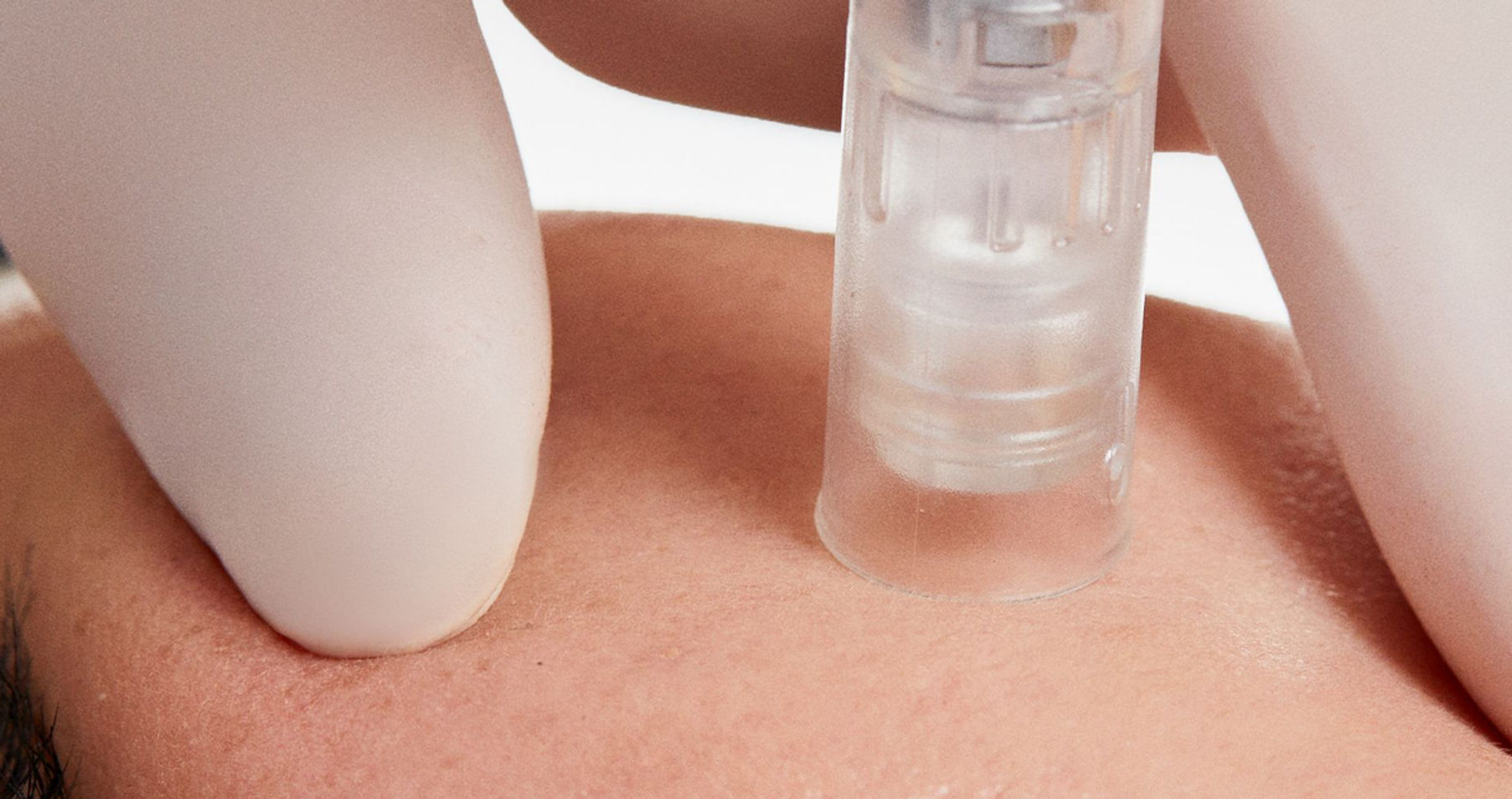 1x1 Microneedling - Model 4.jpg