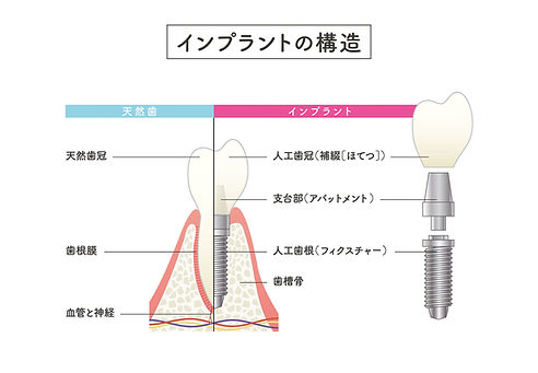 インプラントの構造図