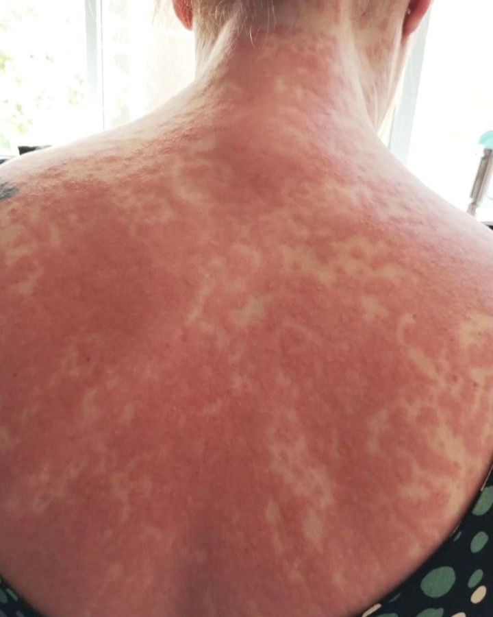 A person's upper back with red, blotchy rash, visible indoors by a window. A green patterned garment is slightly seen below.
