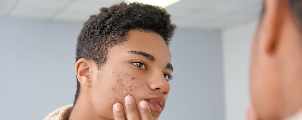 a young black male inspects his face in a mirror. his cheeks have acne outbreak