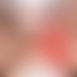 Infarto Silencioso é mais Comum em Mulheres