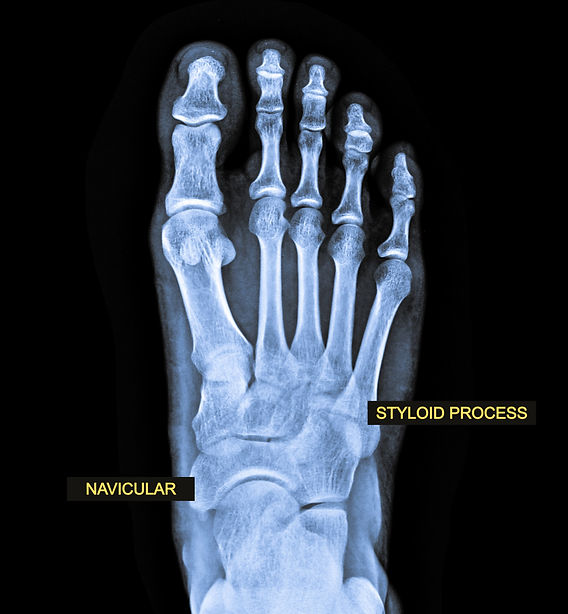 Button Sign Navicular Navicular Bone Anatomy Radiology