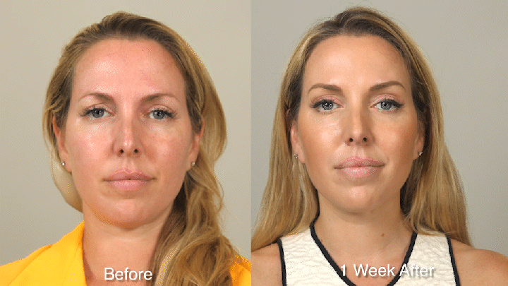 Wrinkle Treatment Patient 1 Raise Front.gif