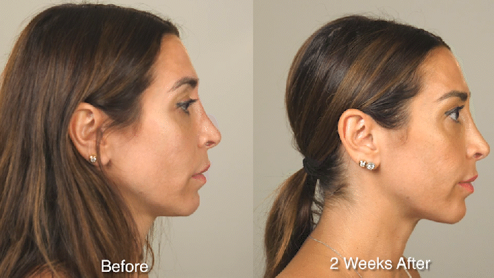 Wrinkle Treatment Patient 2 Smile Side.gif