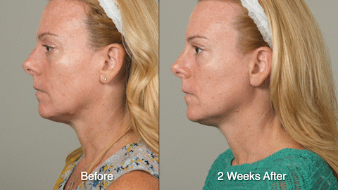 Wrinkle Treatment Patient 3 L Prof Neck_2.gif