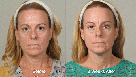Wrinkle Treatment Patient 3 Frown_5.gif