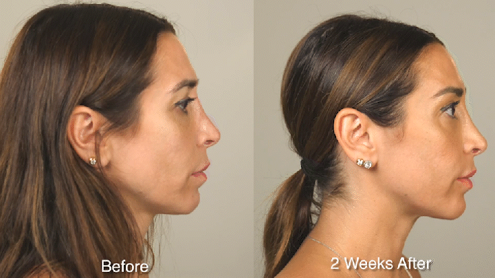 Wrinkle Treatment Patient 2 Frown Side.gif