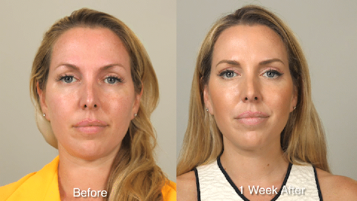 Wrinkle Treatment Patient 1 Smile Front.gif