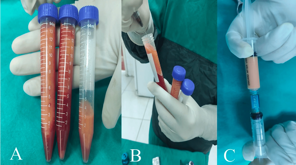 Efficacy of Facial Scar Treatment Techniques Using Nanofat Grafting: A Case Series: Nanofat grafting represents one of the most promising developments in regenerative facial aesthetics. By leveraging the regenerative capacity of adipose-derived stem cells and stromal vascular components, nanofat may offer benefits that extend beyond simple volume restoration. Office-Based Liposuction & Facial Fat Transfer.