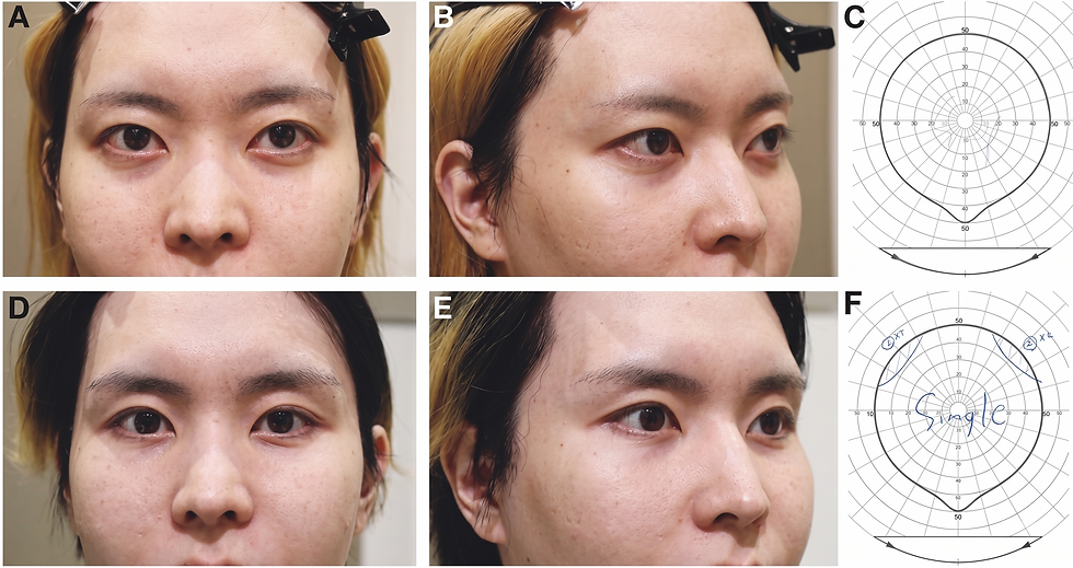 The Deep Plane of Blepharoplasty: Addressing Nonthyroidal Proptosis. A technique-focused review of Yoshida, Kashima, and Kikuchi’s 23-patient case series. Learn Blepharoplasty Techniques from expert surgeons in Japan this coming December. IFAAS Mini-Fellowship Series: Asian Blepharoplasty: Japan Edition.