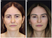 Key Indications of Transtemporal Endoscopic Deep Plane Facelift (TEDPF)