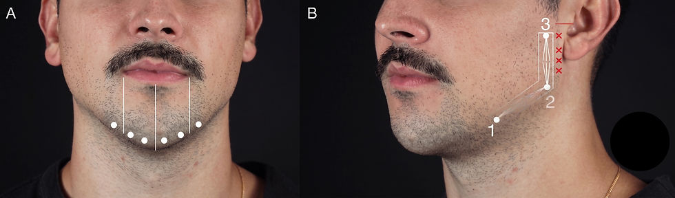 Chin and Jawline Filler: A Precision-Based Approach to Natural Lower-Face Definition, IFAAS Japan In-OR Fellowship Series Japanese Tailored Aesthetic Injectables & Combination Therapies. Targeted combination of deep chin support and subcutaneous mandibular contouring can produce measurable short-term improvements with high patient satisfaction and few transient adverse effects. Ultrasound and 3D imaging add valuable objective information about injection depth, filler behavior, and facial change.