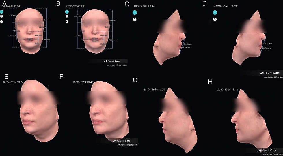 Chin and Jawline Filler: A Precision-Based Approach to Natural Lower-Face Definition, IFAAS Japan In-OR Fellowship Series Japanese Tailored Aesthetic Injectables & Combination Therapies. Targeted combination of deep chin support and subcutaneous mandibular contouring can produce measurable short-term improvements with high patient satisfaction and few transient adverse effects. Ultrasound and 3D imaging add valuable objective information about injection depth, filler behavior, and facial change.