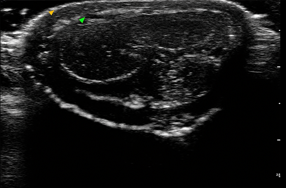 What lies beneath a penile HA filler result? An ultrasound-documented case reveals how anatomy, filler placement and distribution shaped one patient’s outcome, while longer studies offer insight into contour and durability. IFAAS Non-Surgical Intimate Rejuvenation – Thai Edition - Female & Male Treatments with Injectables & Energy-Based Devices.