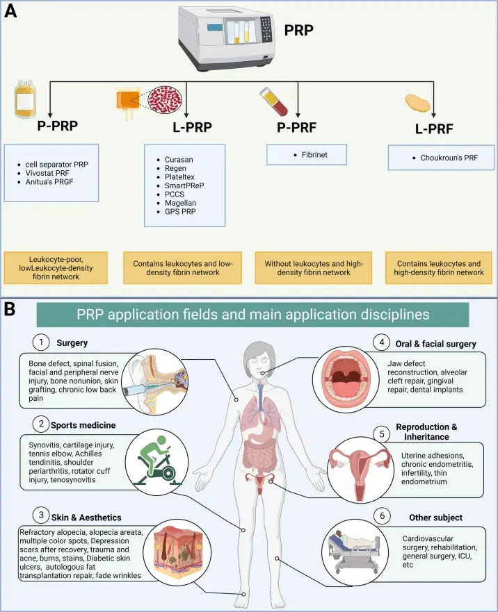 Autologous PRP Injection into the Anterior Vaginal Wall for Female Sexual Health and Function. Regenerative medicine approaches, particularly platelet-rich plasma (PRP), have emerged as a biologically plausible intervention aimed at enhancing tissue vascularity, neurogenesis, and extracellular matrix remodeling within genital tissues. Non-surgical Aesthetic Gynaecology: Injectables & Light Based Devices.
