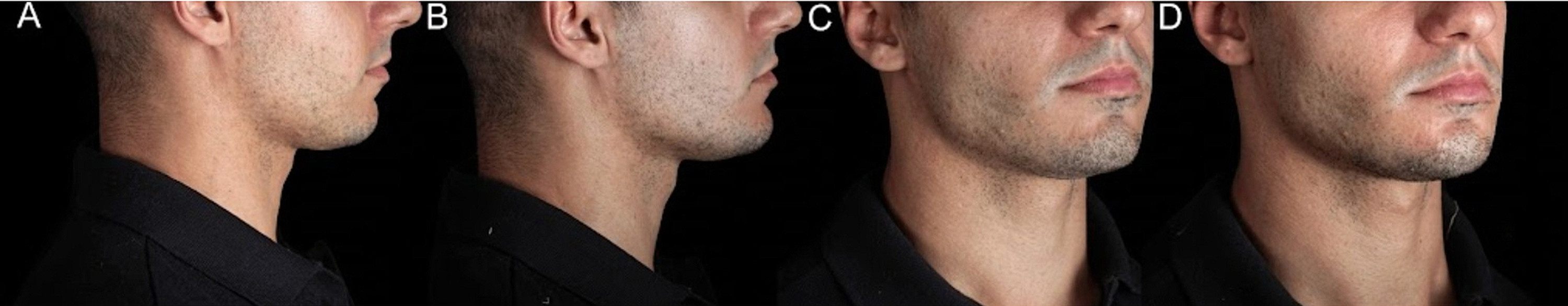 Chin and Jawline Filler: A Precision-Based Approach to Natural Lower-Face Definition, IFAAS Japan In-OR Fellowship Series Japanese Tailored Aesthetic Injectables & Combination Therapies. Targeted combination of deep chin support and subcutaneous mandibular contouring can produce measurable short-term improvements with high patient satisfaction and few transient adverse effects. Ultrasound and 3D imaging add valuable objective information about injection depth, filler behavior, and facial change.