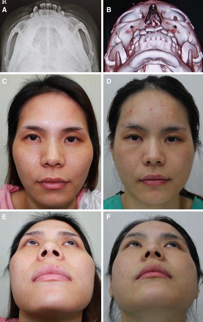 The Role of Coronal Access in Modern Zygoma Reduction Surgery, Korean Advanced Facial Aesthetic Surgeries - Asian Rhinoplasty & Facial Bone Contouring , zygoma reduction surgery
coronal approach facial contouring
malar reduction techniques
zygomatic arch reduction
facial bone contouring surgery, IFAAS, Mini Fellowships, Trainings, Seoul, zygomatic complex anatomy
facial skeletal biomechanics
osteotomy stability zygoma
craniofacial surgical approaches
aesthetic craniofacial surgery
midfacial 