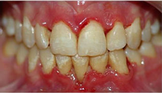 periodontal2.jpg