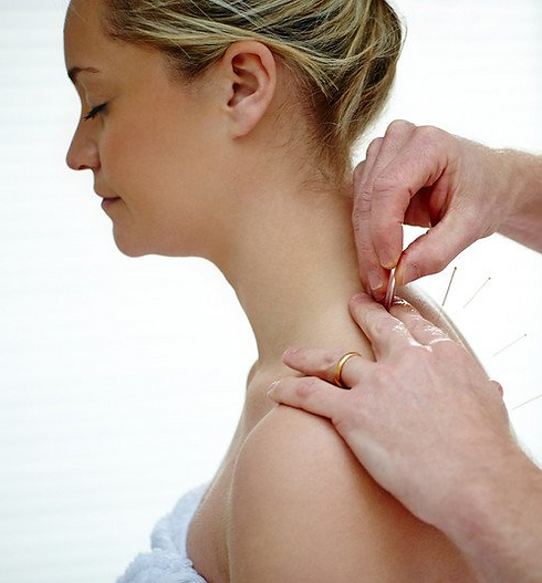 acupuncture needles being placed in woman's shoulder.png
