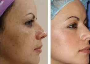 Chemical Peel before/after