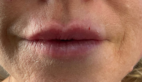 Lips after filler: restored Cupid's bow