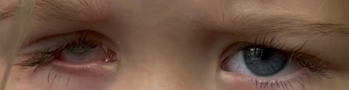 Traitement de la Microphtalmie Prothelem ocularistes Paris