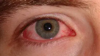 Conjunctivitis: Causes, Symptoms, Treatment, and Prevention