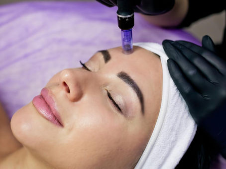 microneedling viso