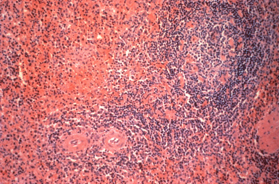 Understanding Inflammation: How Your Diet Can Help