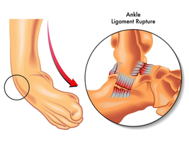 The Right way to Heal an Ankle Sprain