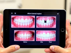 Dentist in Austin discussing low-cost dental implant solutions with a patient.