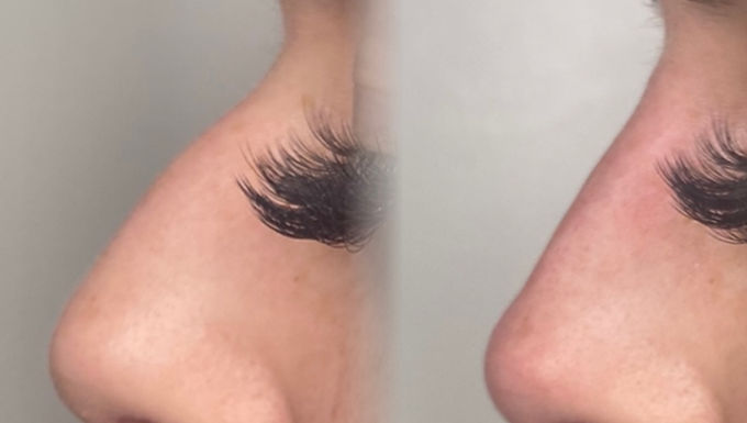 Non-Surgical Rhinoplasty Worthing | Pearl Aesthetics