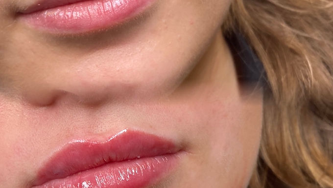 Lip Filler in Worthing | Pearl Aesthetics