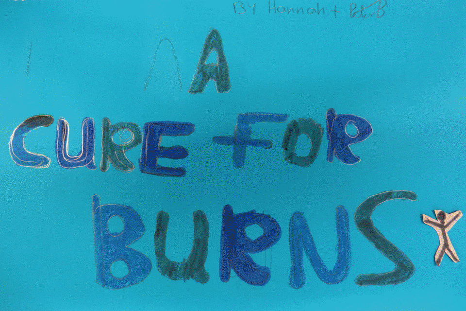 Cure for Burns Hannah Ayland and Peter