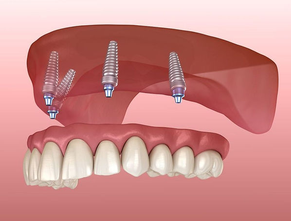 implant prescot rainhill