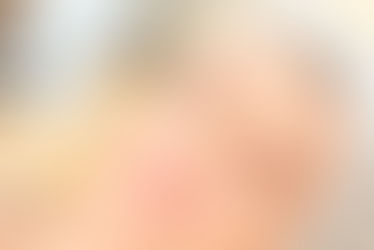 Preenchimento facial com ácido hialurônico