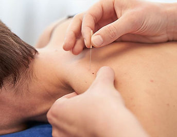 dry-needling-2.jpg