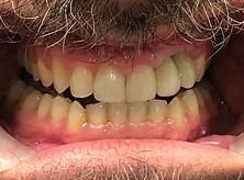 4122251_Owen_Jason_Anterior Open Bite.JPG
