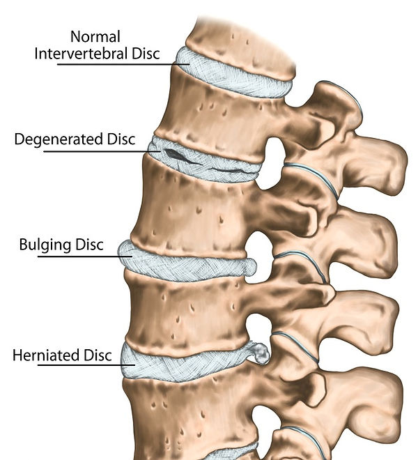 Spinal Disc Conditions (1).jpg