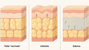 Ritenzione idrica vs cellulite: differenze, come riconoscerle e come contrastarle