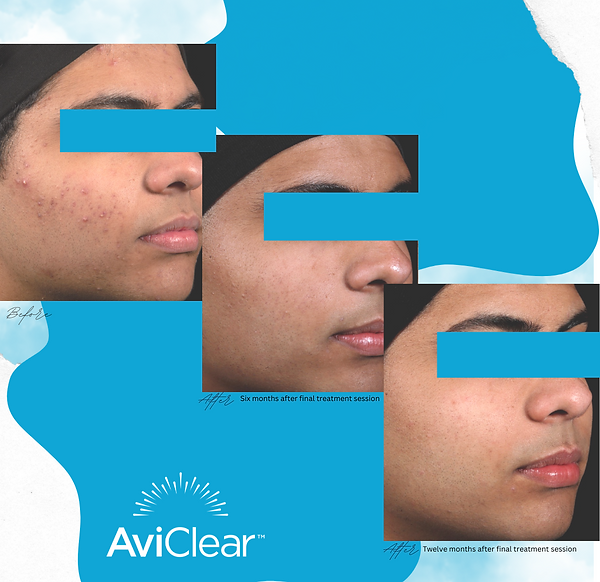 Acne Instagram Post (1).png