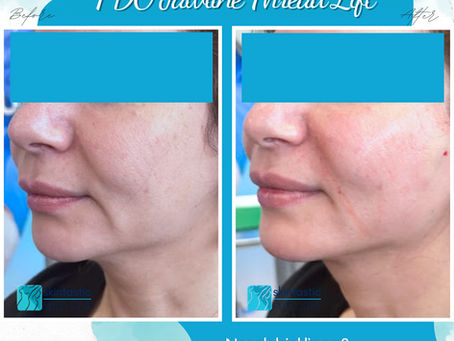 Combining Skin Tightening Techniques for Enhanced Results