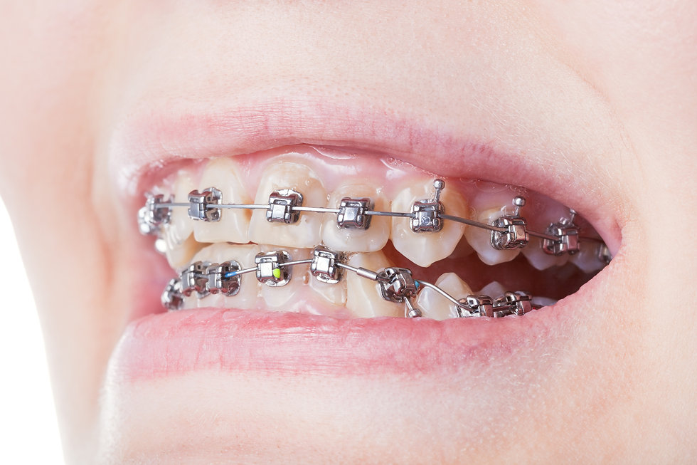 Damon Braces.jpeg
