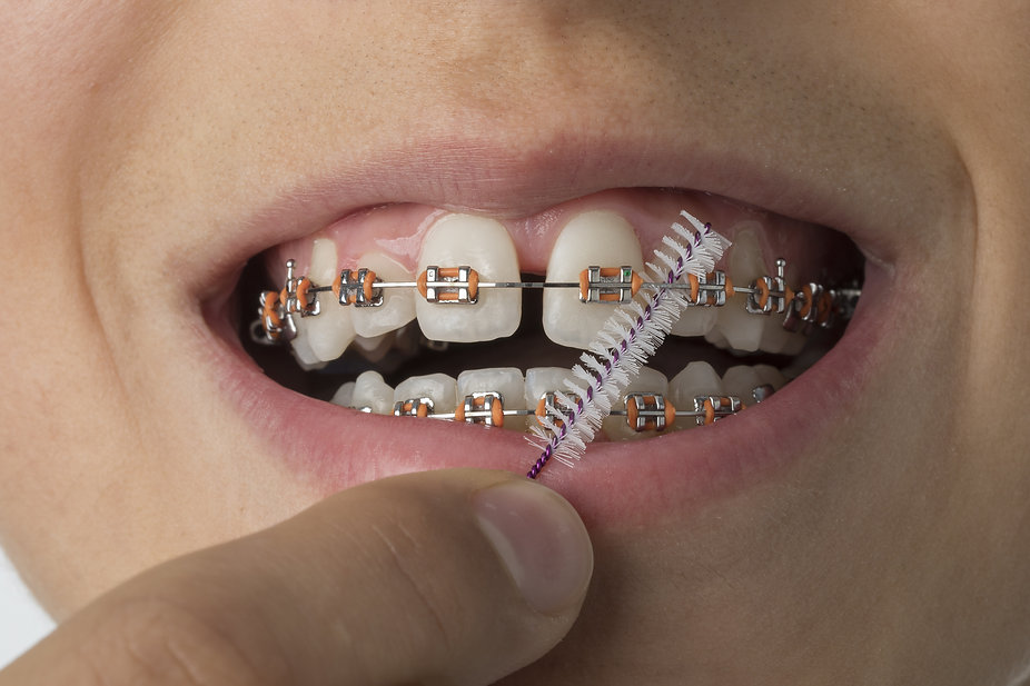 Life with braces.jpeg