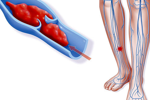 simptomy-lechenie-tromboza.jpg