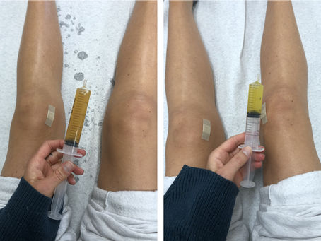 What is a joint aspiration and how is it used in the treatment of arthritis?