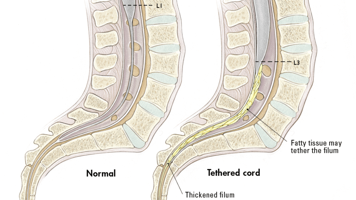 tethered-spinal-cord-syndrome-what-you-need-to-know.gif