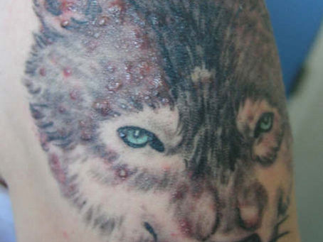 Help! Mijn tatoeage is ontstoken!
