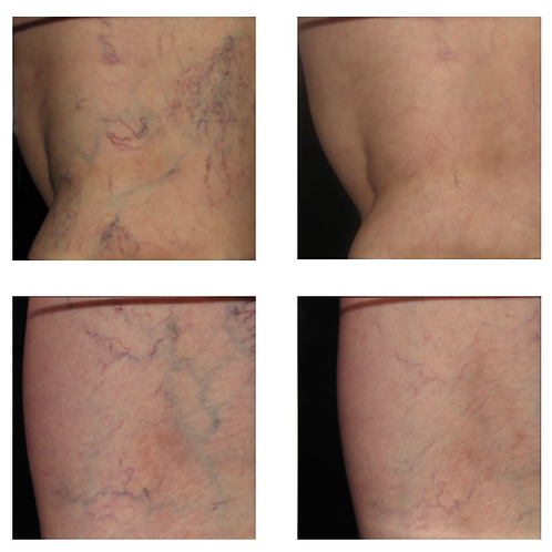 Before and after treatment with Asclera to reduce the appearance of spider veins